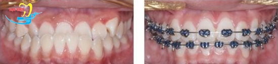 Kết quả chỉnh răng bị móm bằng niềng răng