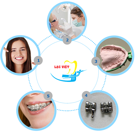 Quy trình niềng răng móm không cần phẫu thuật