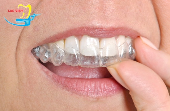 niềng răng invisalign có tốt không phụ thuộc vào chính bệnh nhân