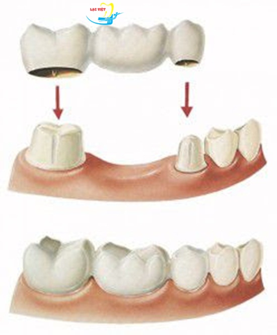 trồng răng là gì được tiến hành ra sao với làm cầu răng?
