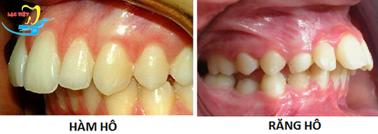 Phân biệt hàm hô với răng hô và cách sửa răng hô