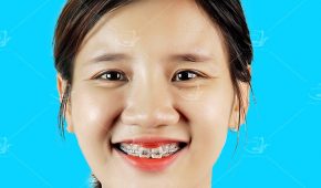 Khuyến mại niềng răng – chương trình tỏa sáng nụ cười Việt.