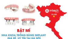 Bật mí nha khoa trồng răng implant giá rẻ, uy tín tại Hà Nội