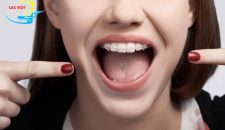 Lý do bạn nên lựa chọn niềng răng mắc cài sứ?