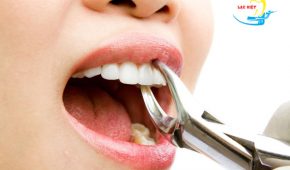 Nhổ răng khểnh không đúng chỗ có dễ dàng không?