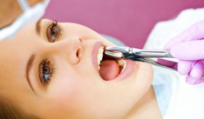Nhổ răng để niềng có ảnh hưởng gì không và tại sao phải nhổ?