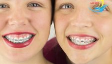 Niềng răng cho trẻ em lúc nào là hợp lý và ở đâu tốt nhất?