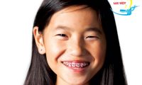 Niềng răng cho trẻ em giá bao nhiêu và phương pháp tiết kiệm nhất