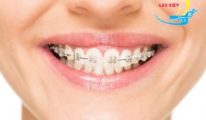 Quy trình niềng răng diễn biến ra sao?