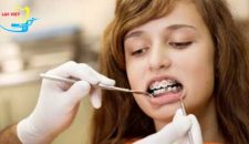 Niềng răng móm có đau không – Giải đáp từ chuyên gia nha khoa