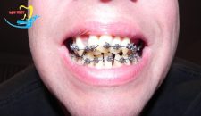 Chuyên gia nha khoa giải đáp: Niềng răng khểnh mất bao lâu?