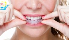 Thời gian niềng răng không mắc cài mất bao lâu?
