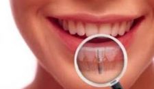 Cắm ghép răng implant có đau và nguy hiểm gì không?
