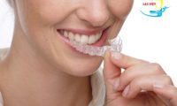 Giá niềng răng không mắc cài bao nhiêu và ở đâu có giá tốt nhất?