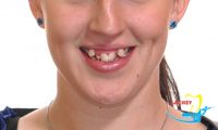 So sánh niềng răng với bọc răng sứ thẩm mỹ cho răng khấp khểnh